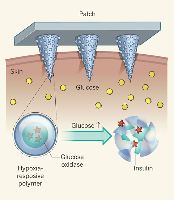 "Smart Insulin" Still Being Researched for Diabetes
