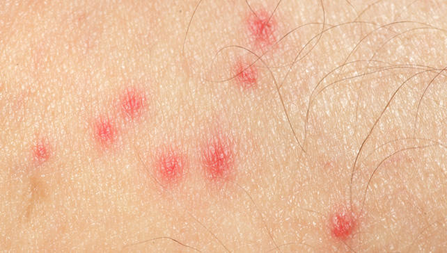 Itchy Bumps On Skin Like Mosquito Bites Causes