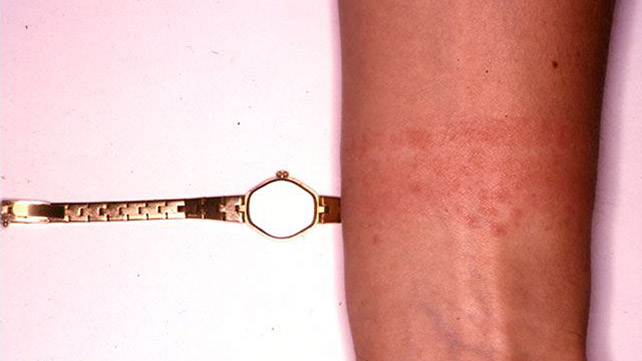 7 Types Of Eczema Symptoms Causes And Pictures 7 Types Of Eczema Symptoms Causes And Pictures