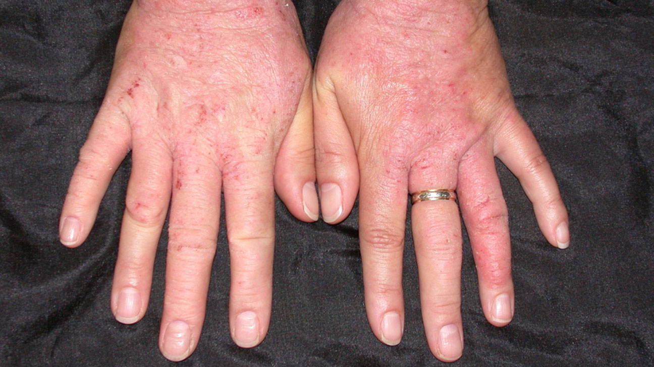 Skin Disorders Pictures, Causes, Symptoms, Treatments Richmond Hill
