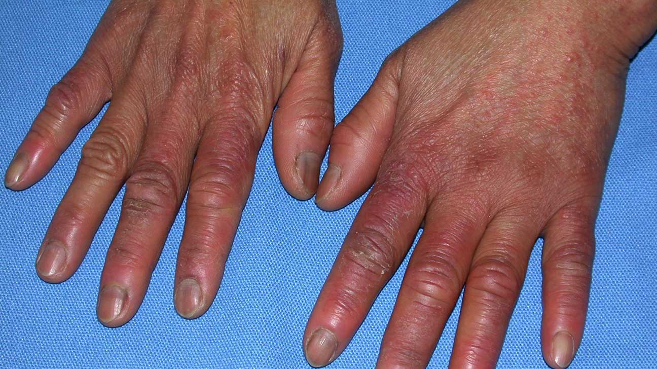 Premium Photo | Finger swollen with inflammation due to nail ripped  infection children's hands with a tear near the nail of the index finger  the consequence of biting your nails