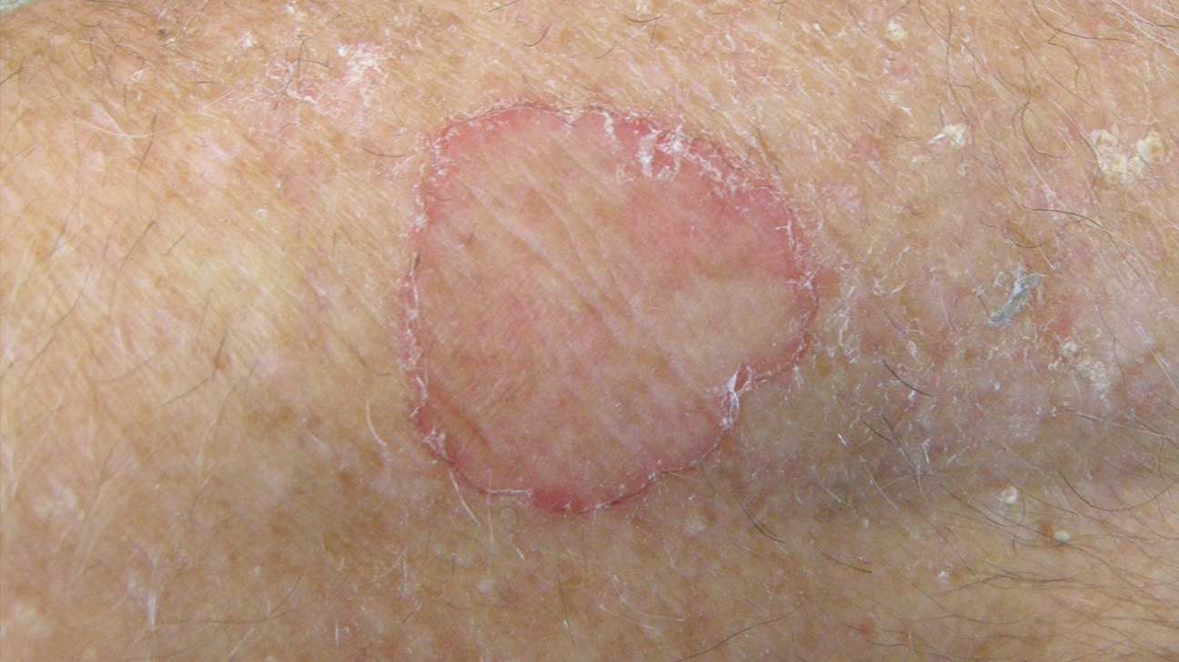 Porokeratosis: Causes, Treatment, and More