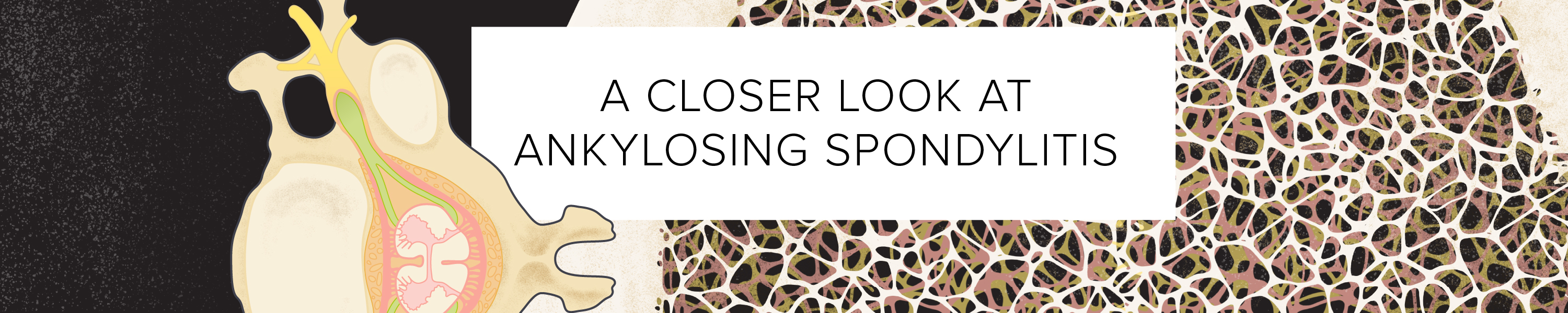 A Closer Look at Ankylosing Spondylitis