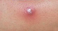 Mrsa Pimple The Differences Between Mrsa And Acne