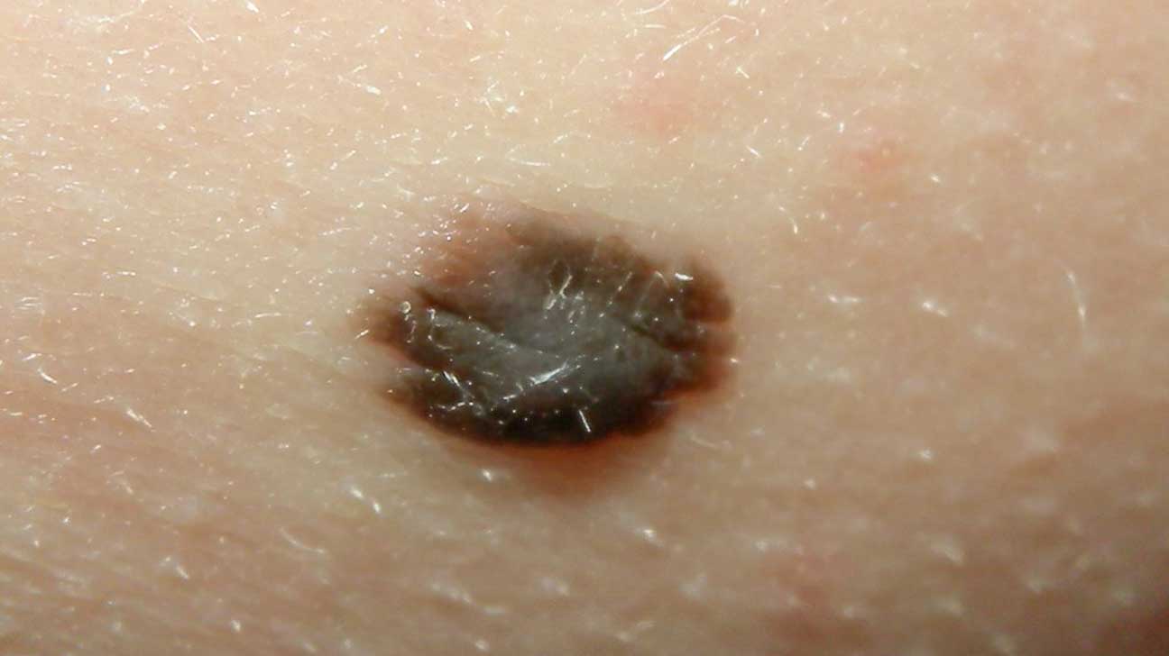 compound nevus mole