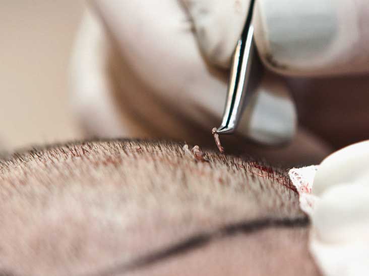 Hair Transplant Scar Is It Permanent Or Can It Be Removed