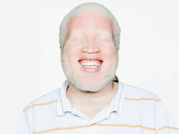 White Hair Causes And Prevention
