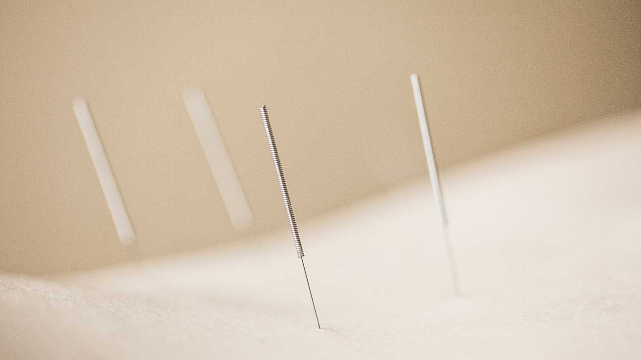 Can Acupuncture Cure Carpal Tunnel Pain?