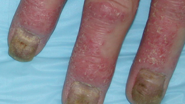 Pictures of Psoriatic Arthritis Symptoms