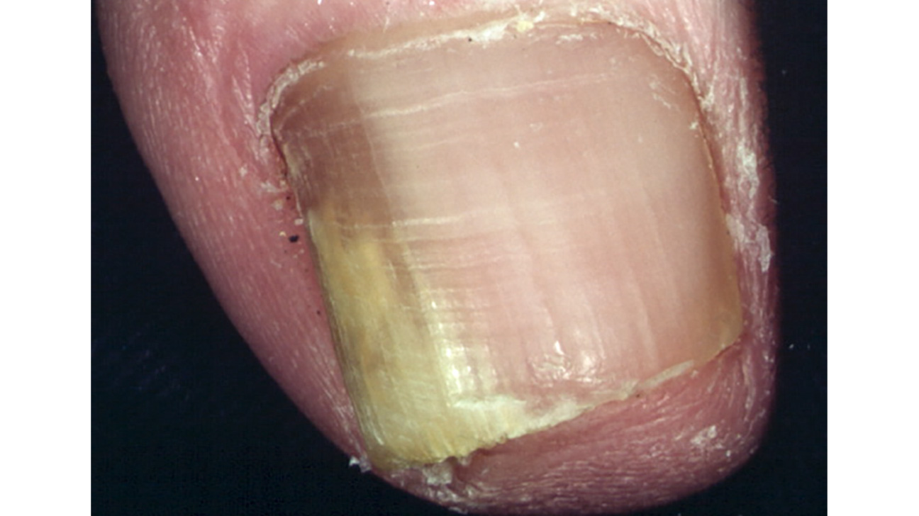 Psoriasis Nail Bed Separation Nail Ftempo