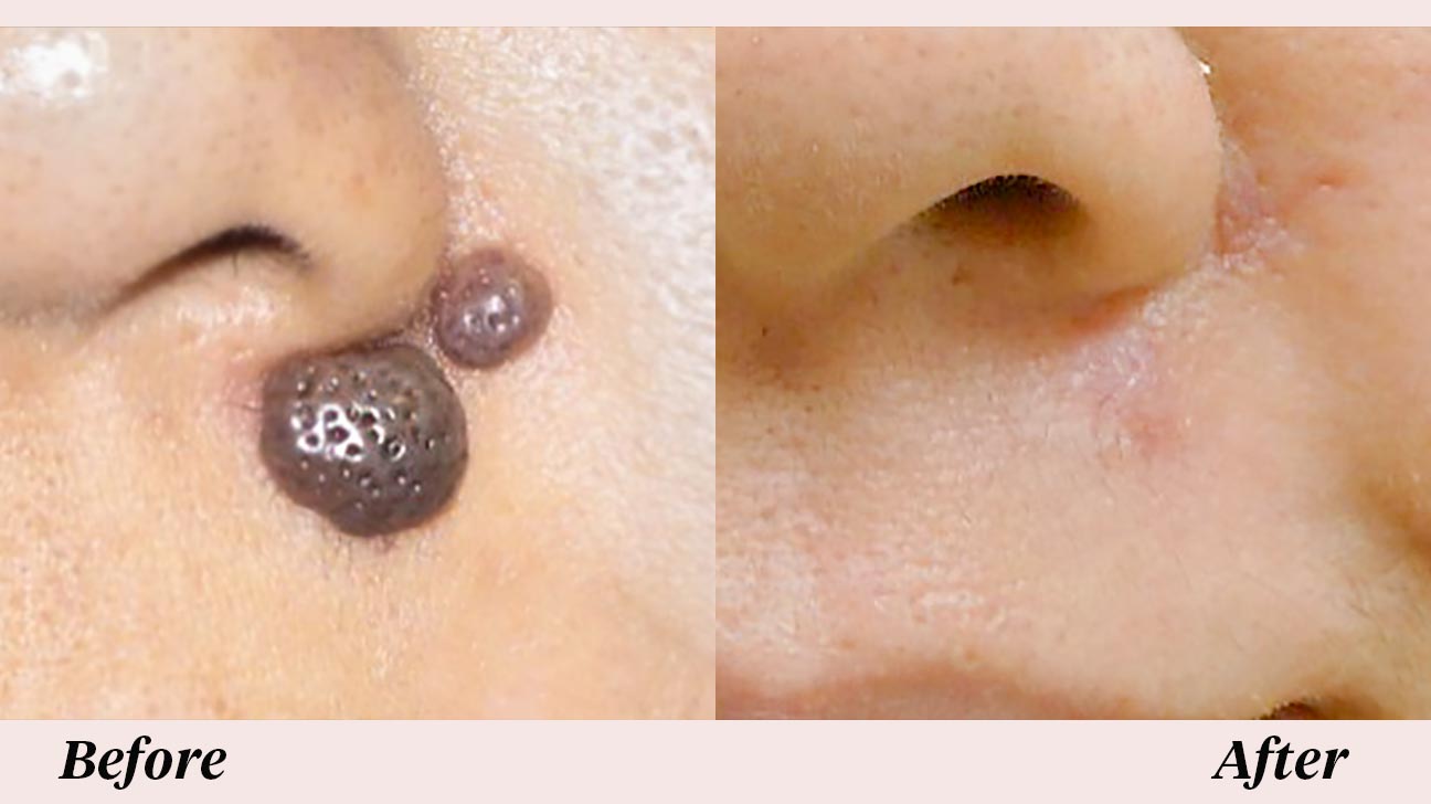 Mole Removal What To Expect Before And After Procedure UJPU