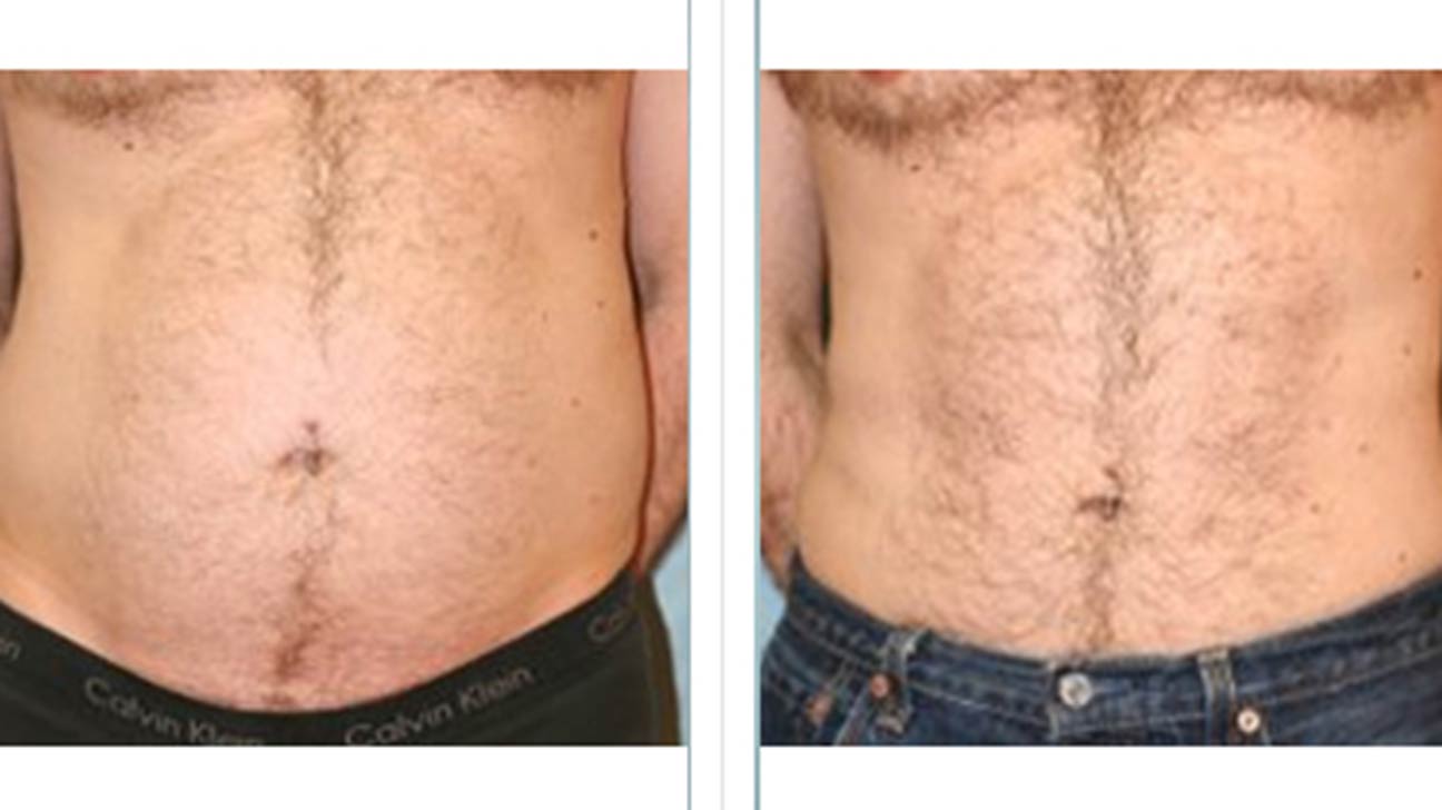 Hips Back Fat Loss Treatment Men - LA Lipo Cryolipolysis