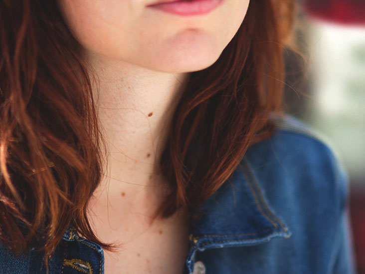 Painful Mole Vs Melanoma Signs Skin Changes To Know
