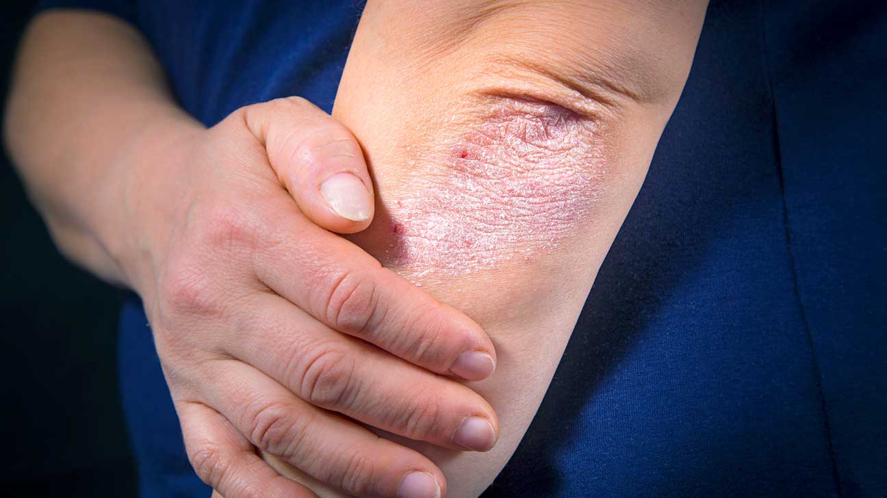 Psoriasis Vs Fungal Infection Tips For Identification And Treatments