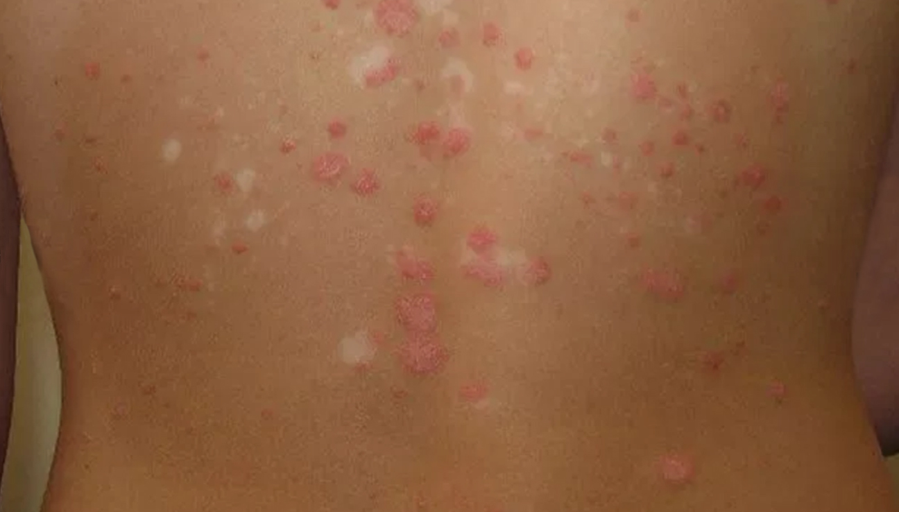 Discoid Psoriasis Pictures