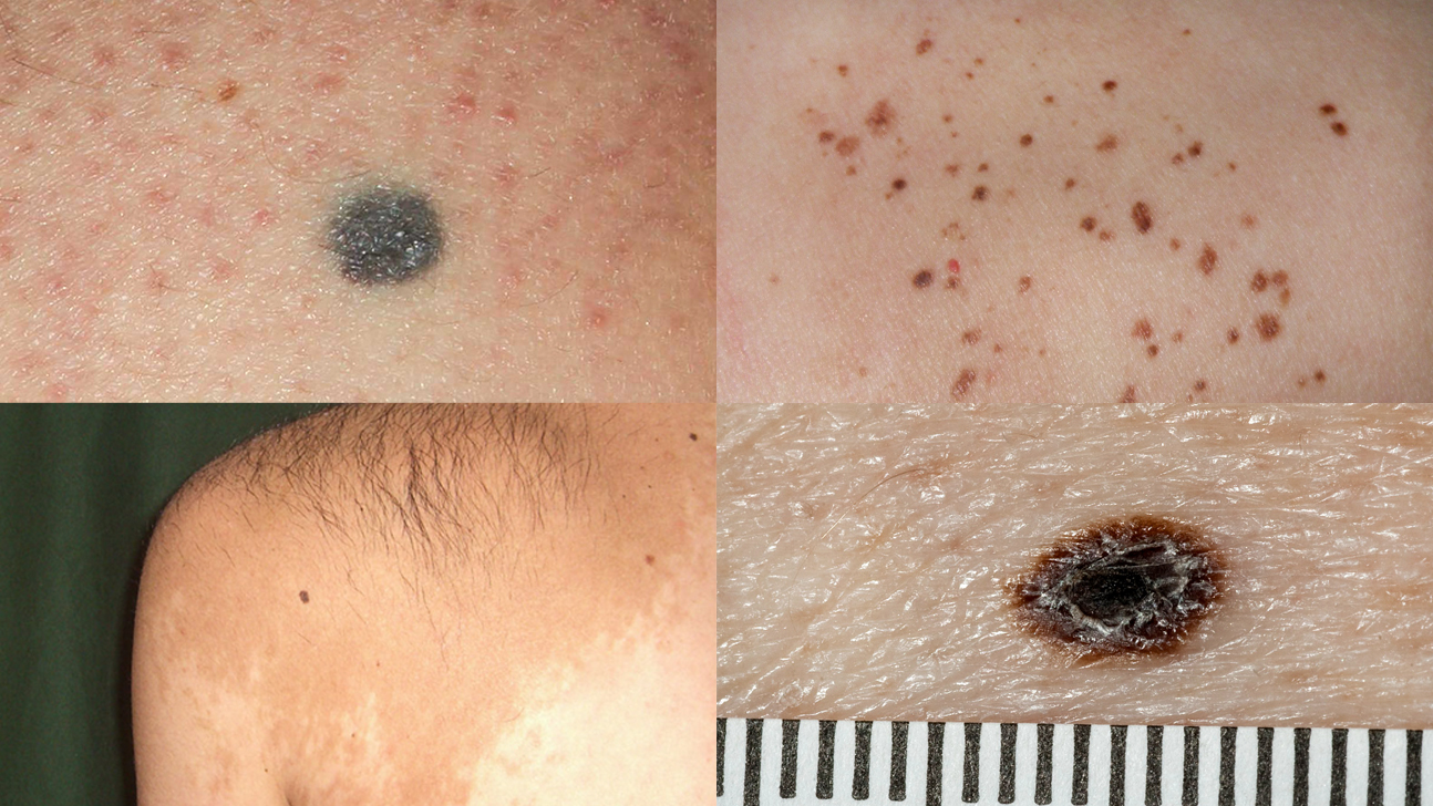 Skin Moles