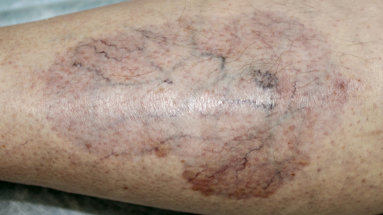 show me diabetic skin conditions pictures