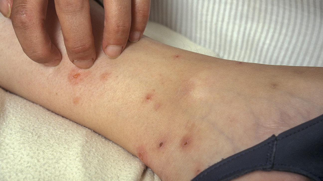 Flea Bites Carpets Carpet Vidalondon