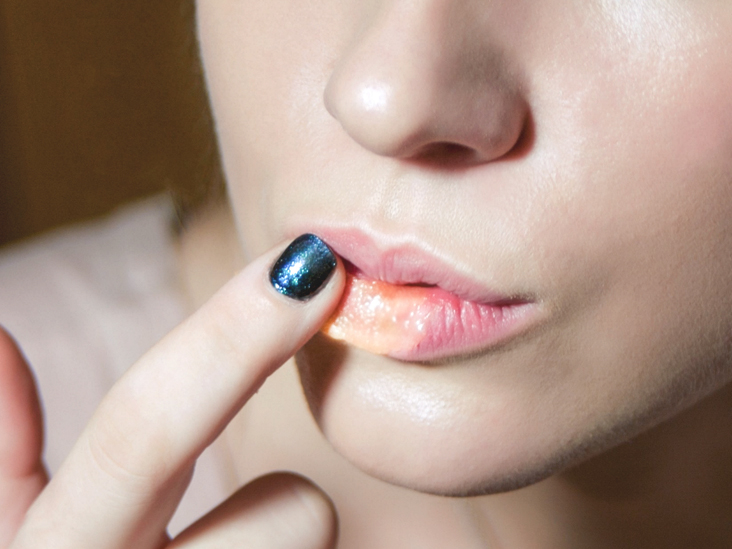 How to Heal a Busted Lip: 5 Home Remedies