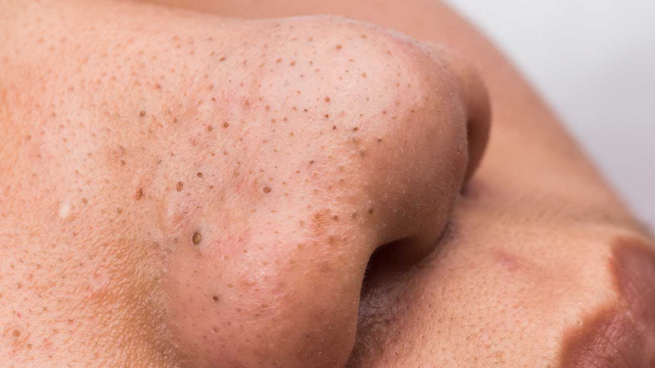 How to get rid of blackheads, according to a dermatologist