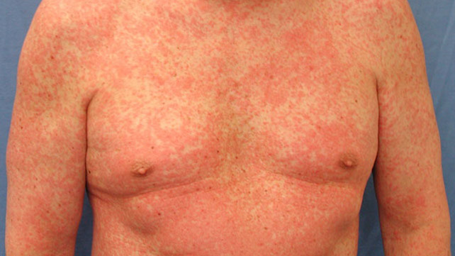 Misdiagnosis Of Psoriasis Know The Facts