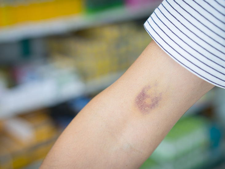 Petechiae Causes Treatments Pictures And More