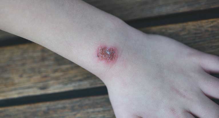 Mrsa Pimple The Differences Between Mrsa And Acne